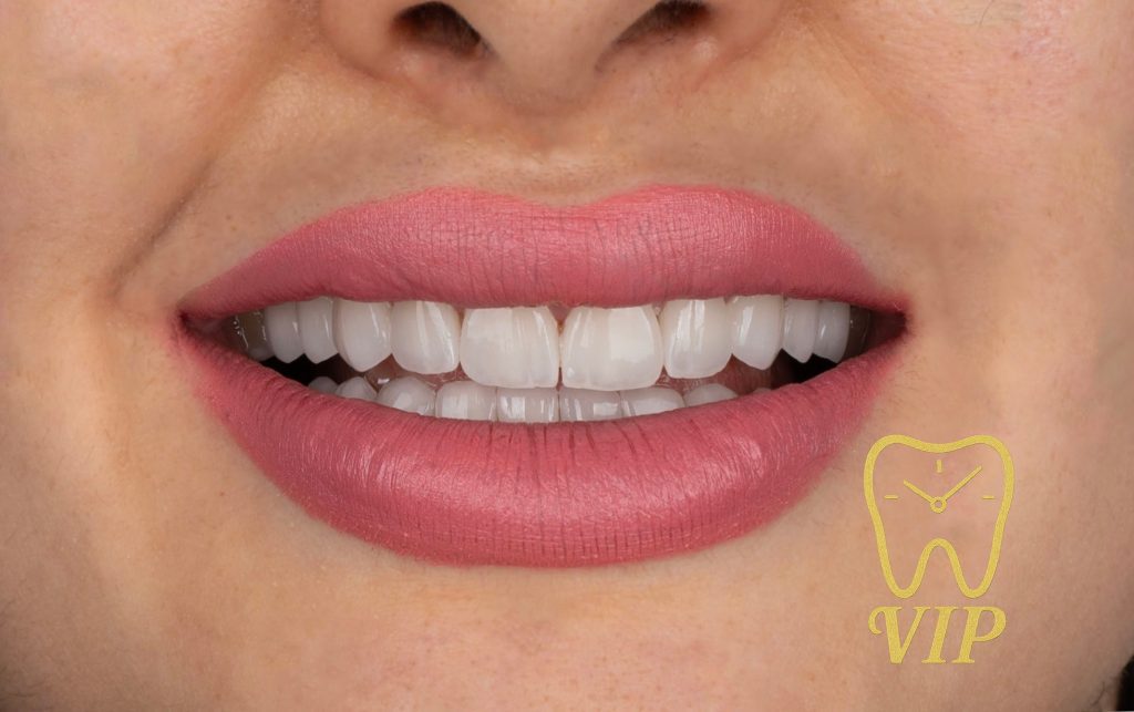 veneers