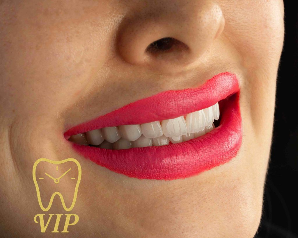 bestveneers