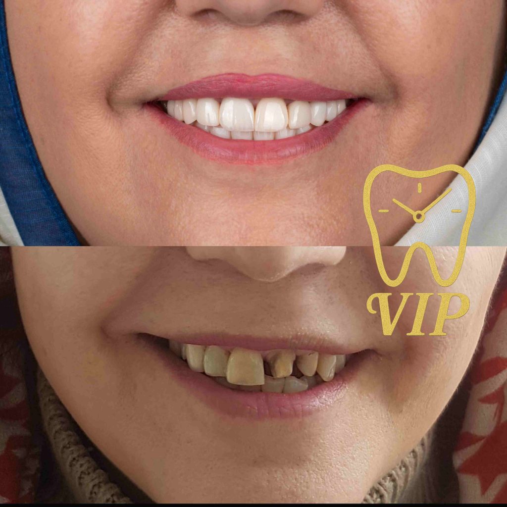 before after dental