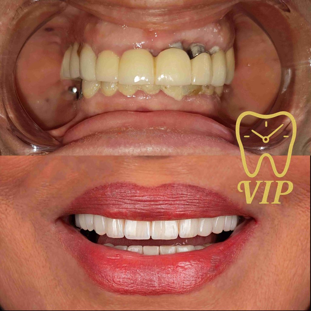 best dentla implant