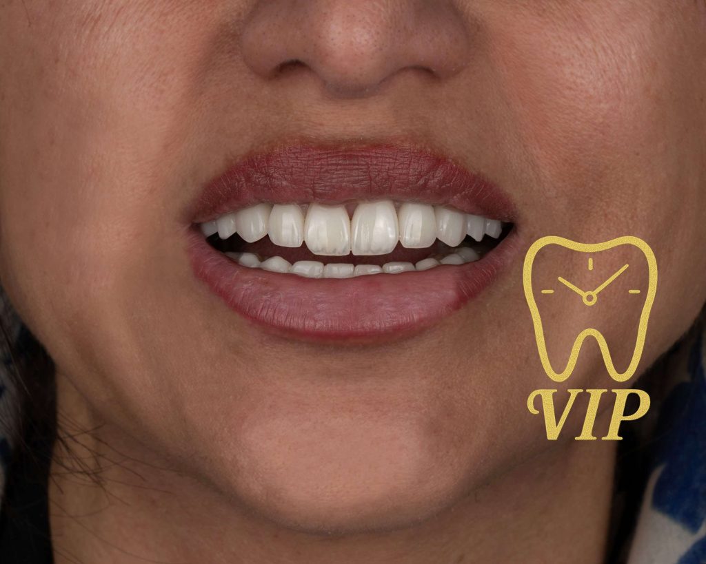 bestdentalveneers