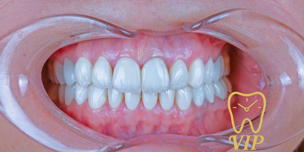 best veneers