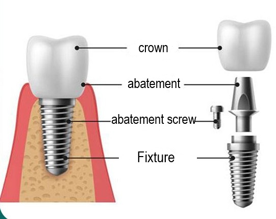 implant