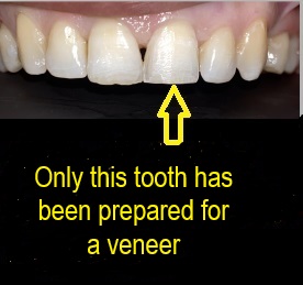 prepared teeth for veneer